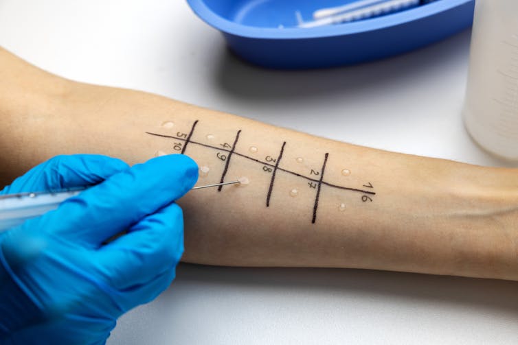 Patient undergoing skin-prick allergy test on arm