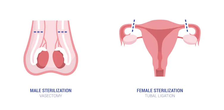 Illustrated anatomical examples of vasectomy on the left and tubal ligation on the right.