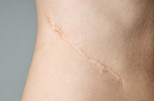 How to treat scars at home – and hopefully make them disappear
