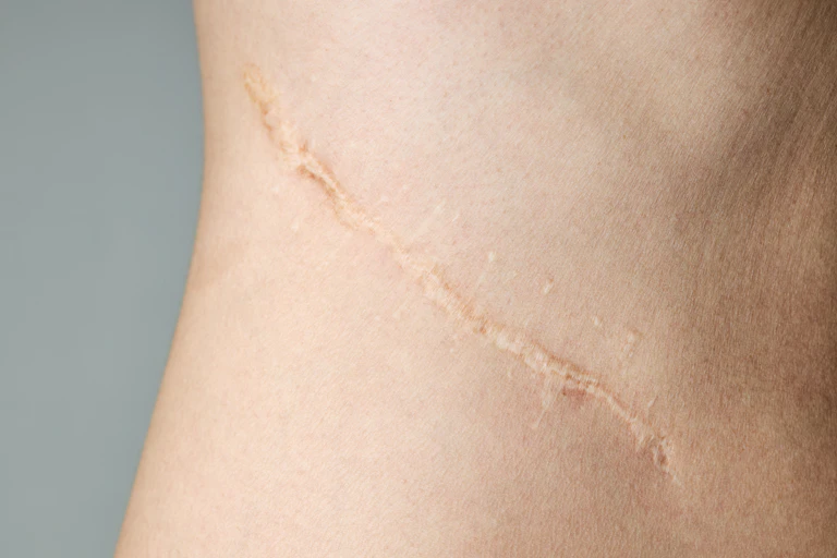 skin with old scar
