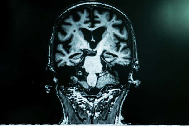 Malade d'Alzheimer avec IRM
