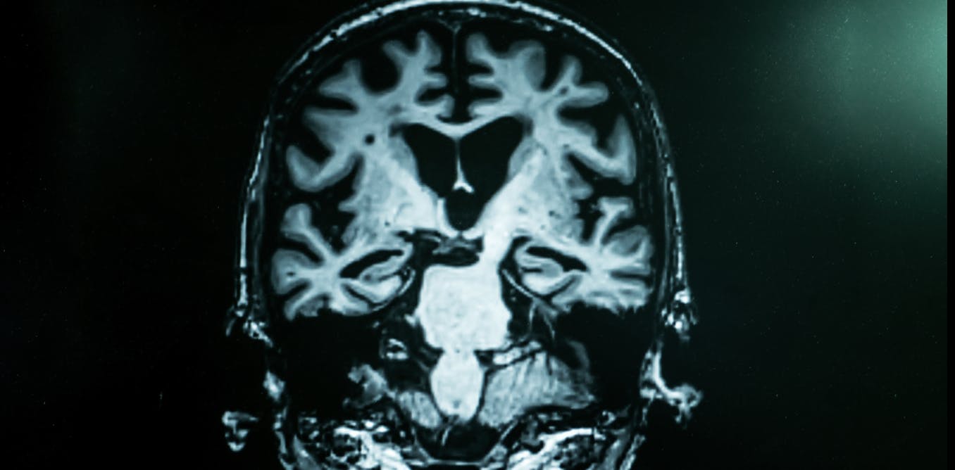 Les métaux sont-ils le chaînon manquant pour comprendre la maladie d’Alzheimer ?