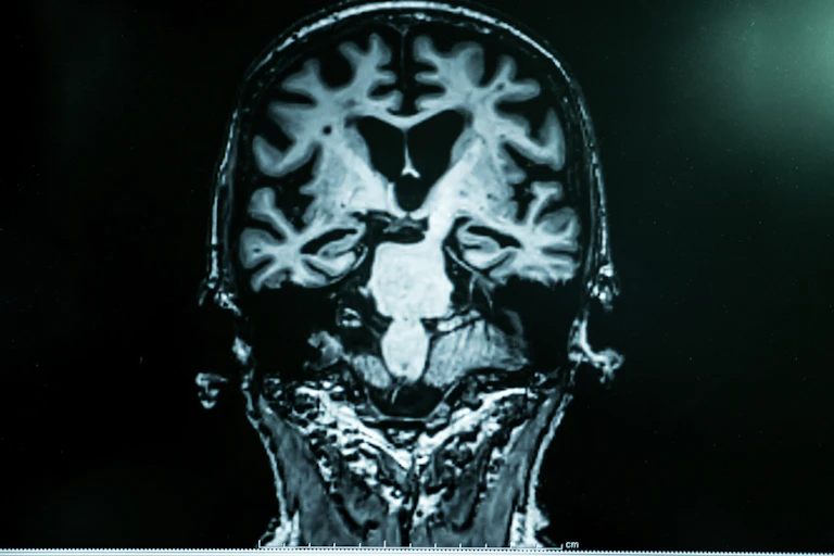 Malade d'Alzheimer avec IRM