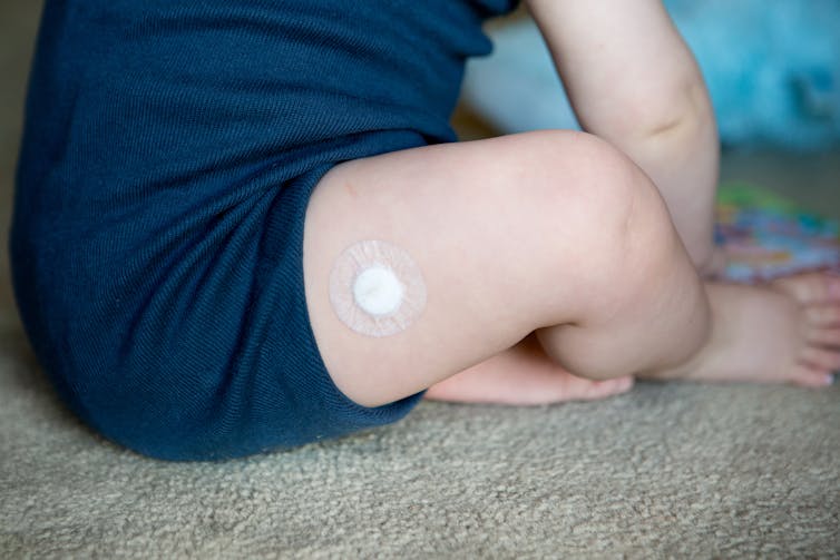 Baby's leg after a vaccination