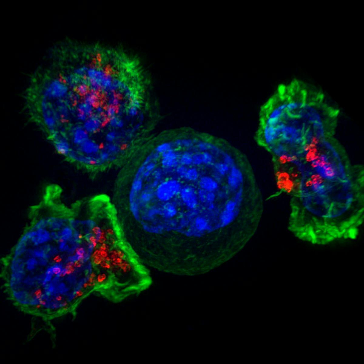 Anti-cancer CAR-T therapy reengineers T cells to kill tumors – and  researchers are expanding the limited types of cancer it can target