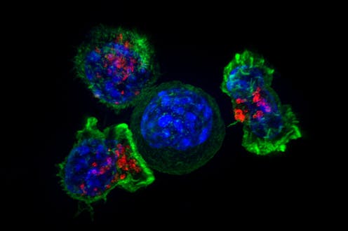 Anti-cancer CAR-T therapy reengineers T cells to kill tumors – and researchers are expanding the limited types of cancer it can target