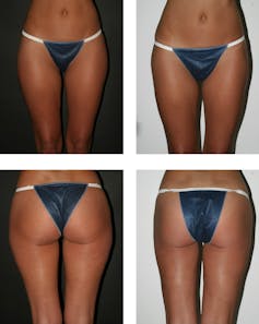 Before and after liposuction on the outer thighs. Otto Placik