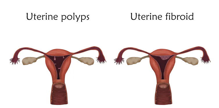 Two images of wombs - one showing dangly growths, and one showing mounded growths.