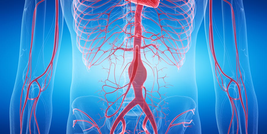 A digital drawing of an abdominal aortic aneurysm. 