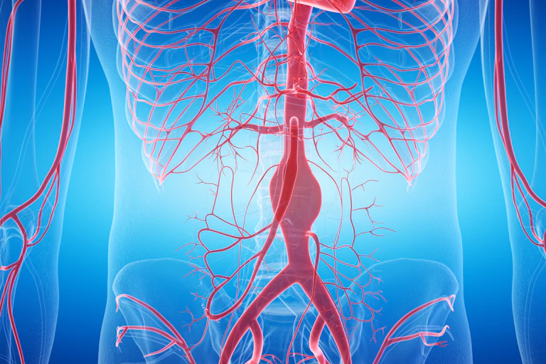 A digital drawing of an abdominal aortic aneurysm.