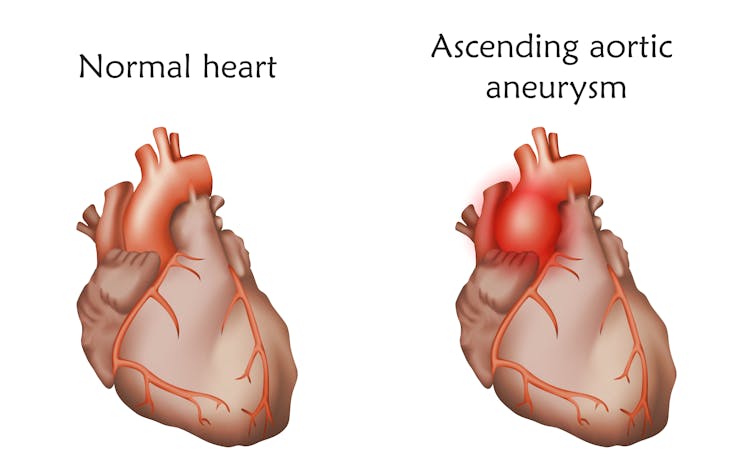 A digital image comparing a normal heart to a heart with a thoracic (ascending) aortic aneurysm.