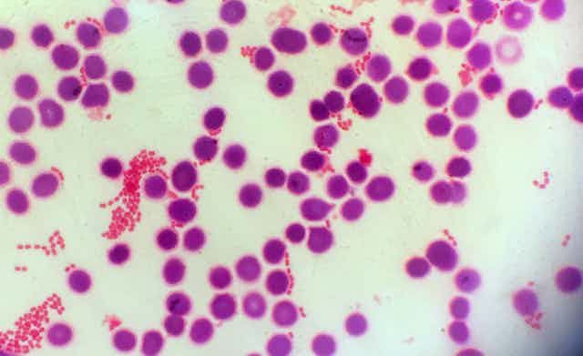 Microscopy image of gram negative bacteria and blood cells