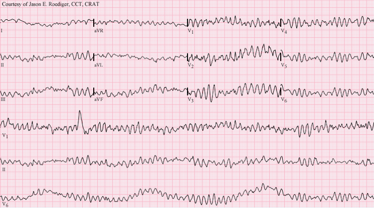 This ECG diagram shows the electrical signals of a heart in ventricular fibrillation.