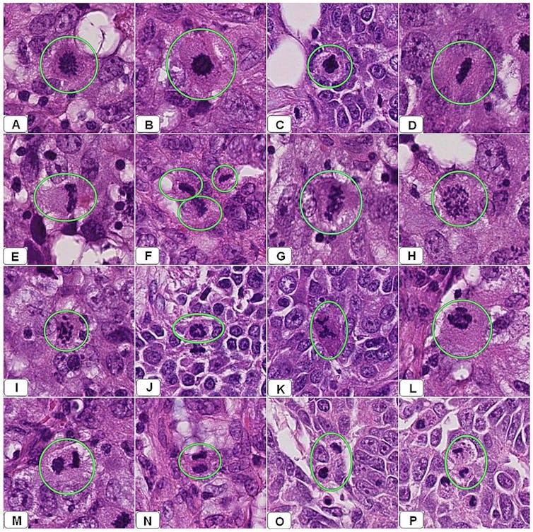 Vues multiples de préparations de cellules cancéreuses de sein