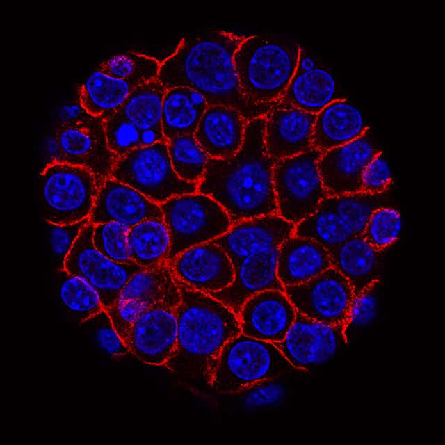 Microscopy image of pancreatic cancer cells