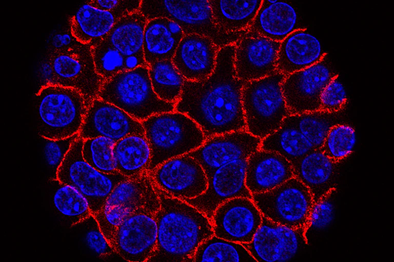 Microscopy image of pancreatic cancer cells