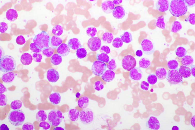 Microscopy image of acute promyelocytic leukemia