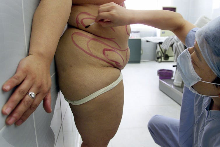 Cosmetic surgeons promote liposuction as a quick and easy weight loss alternative. 