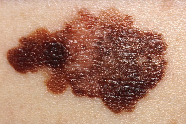 Close-up of melanoma