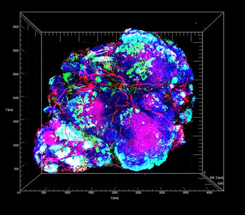 Stopping the cancer cells that thrive on chemotherapy – research into how pancreatic tumors adapt to stress could lead to a new treatment approach