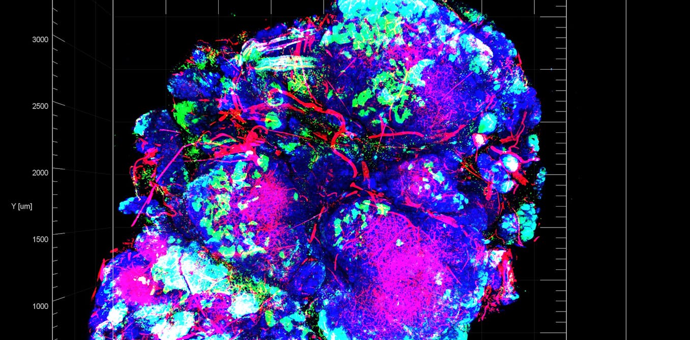 Stopping The Cancer Cells That Thrive On Chemotherapy Research Into stopping-the-cancer-cells-that-thrive-on-chemotherapy-research-into