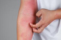 Pinkish splotches of eczema appear on an extended right arm.