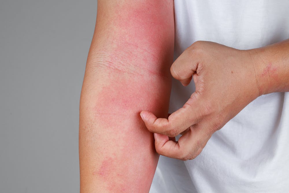 Cold weather brings itchy, irritated, dry and scaly skin – here's how to treat eczema and other skin conditions and when to see a doctor