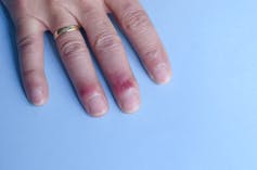 Against a blue background, a woman's hand shows chilblains -- swollen, bright red marks on her middle and ring fingers just below the nails.