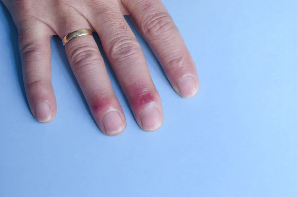Here s How To Treat Eczema And Other Skin Conditions And When To See here-s-how-to-treat-eczema-and-other-skin-conditions-and-when-to-see