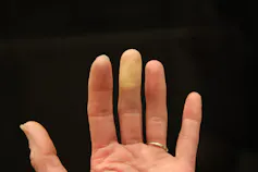Against a black background, an adult hand with a pale middle finger displays Raynaud's phenomenon.