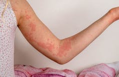 A woman's arm is covered in blotchy red marks known as hives.