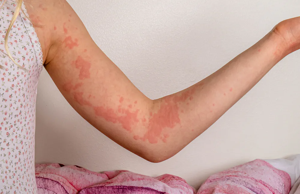 Extreme Cold Rash Cold weather brings itchy, irritated, dry and scaly skin – here’s how ...