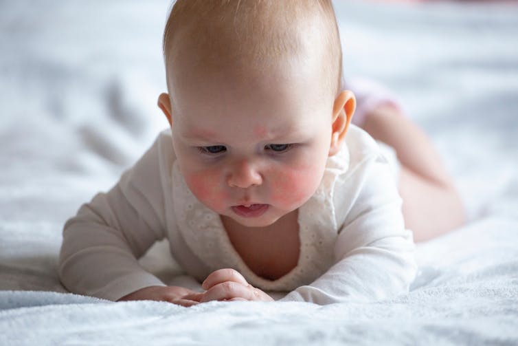 young baby with red cheeks on bed