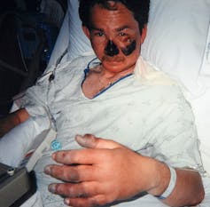 Nigel Vardy à l’hôpital, montrant ses blessures noircies au niveau des mains et du visage (nez et joue)