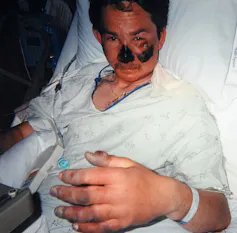 Nigel Vardy à l’hôpital, montrant ses blessures noircies au niveau des mains et du visage (nez et joue)