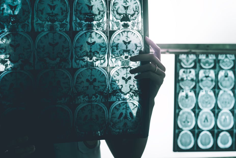 A person holds up images from an MRI scan of a Alzheimer's patient's brain.