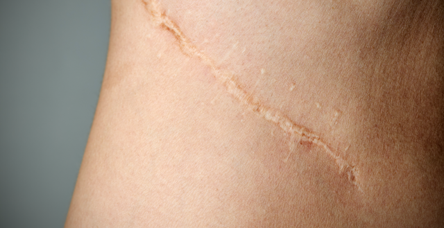 Cicatrices chéloïdes : comment les éliminer ?