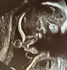 échographie d’un bébé in utero