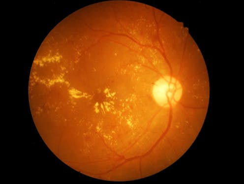 Macular diseases cause blindness and treatment costs millions. Here is how to look after yours