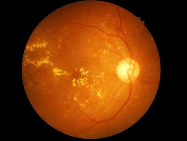 macular degeneration of eye under microscope