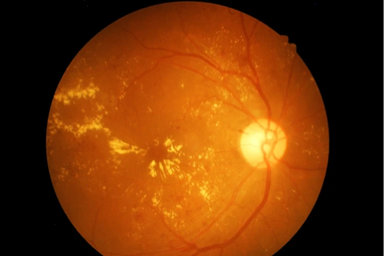 macular degeneration of eye under microscope