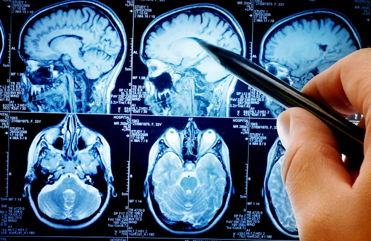IRM de cerveau