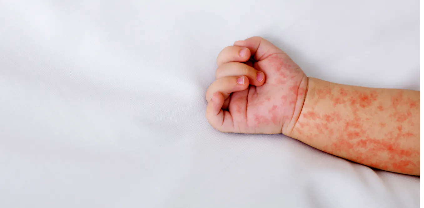 Rougeole, coqueluche, tétanos… Les vaccins restent la meilleure arme mondiale pour protéger les enfants Rougeole, coqueluche, tétanos… Les vaccins restent la meilleure arme mondiale pour protéger les enfants