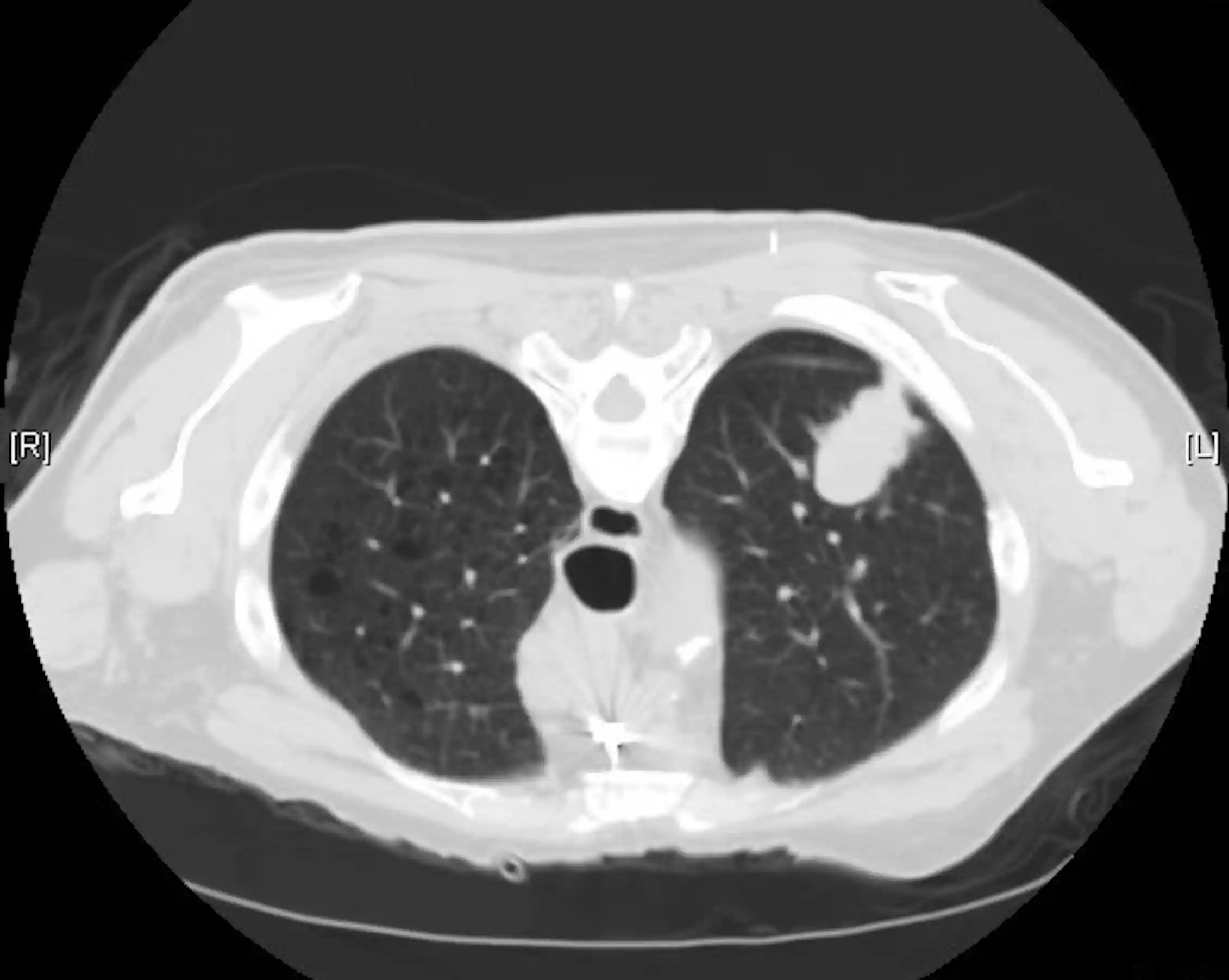 CT scan of lung adenocarcinoma