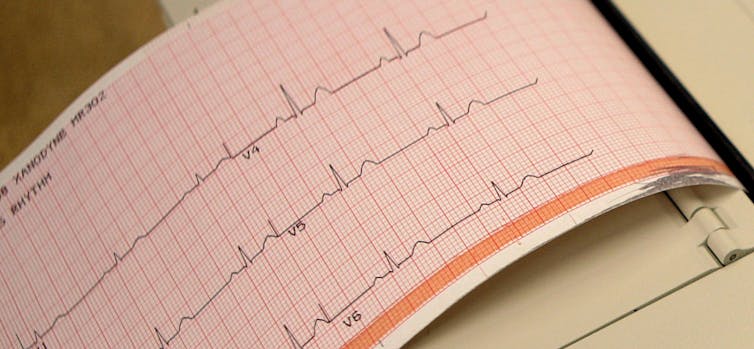 a printout from an electrocardiogram machine