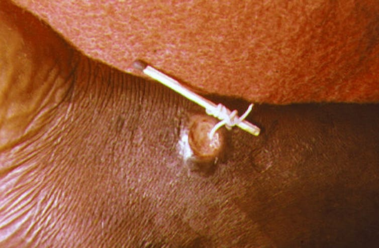 An up-close image of a thin, white Guinea worm emerging through a blister on a human leg, wrapping around a matchstick. 