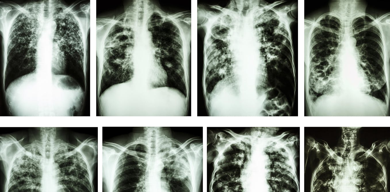 Рентген грудной клетки туберкулез