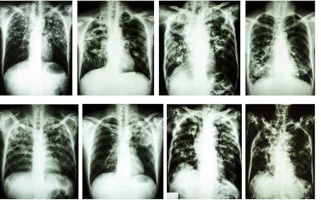 Chest X-rays