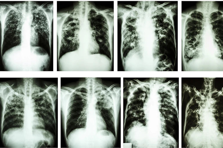 Chest X-rays