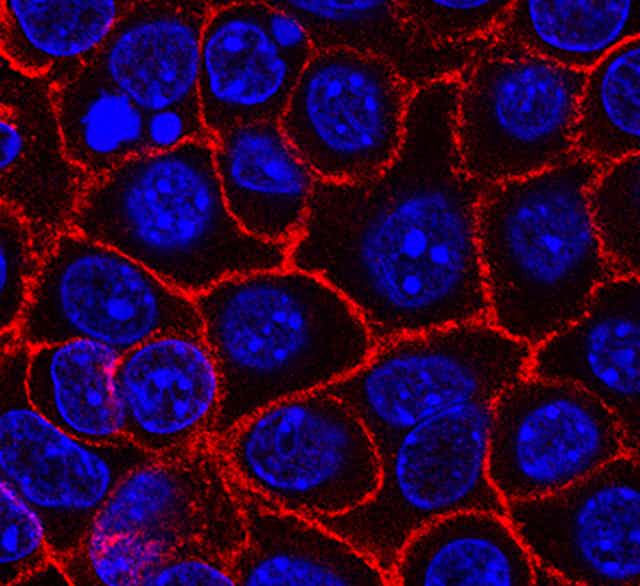 Image de microscopie montrant des cellules cancéreuses du pancréas (en bleu) en croissance (en rouge, les membranes). 